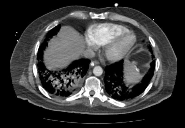 Acute cor pulmonale (ultrasound) (Radiopaedia 83508-98818 Axial C+ CTPA 59).jpg
