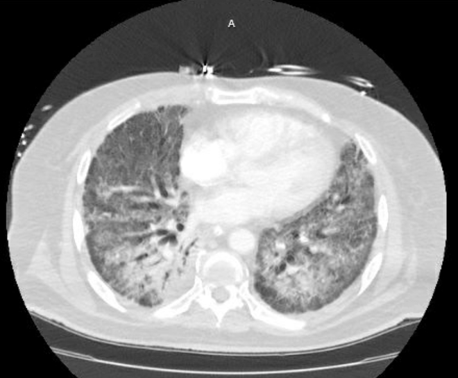 Acute cor pulmonale (ultrasound) (Radiopaedia 83508-98818 Axial lung window 54).jpg