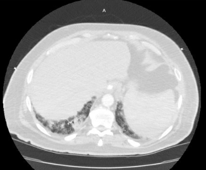 Acute cor pulmonale (ultrasound) (Radiopaedia 83508-98818 Axial lung window 78).jpg