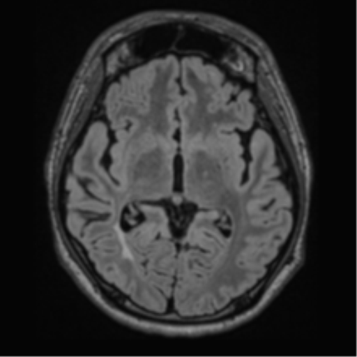 Acute disseminated encephalomyelitis (ADEM)- Anti-NMDA receptor encephalitis (Radiopaedia 54920-61201 Axial FLAIR 32).png