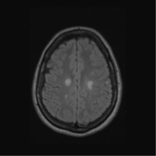 Acute disseminated encephalomyelitis (ADEM) (Radiopaedia 38073-40065 Axial FLAIR 49).png