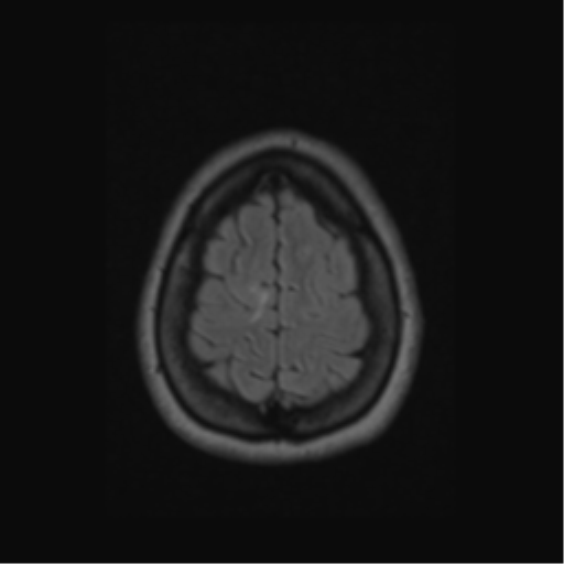 Acute disseminated encephalomyelitis (ADEM) (Radiopaedia 38073-40065 Axial FLAIR 59).png