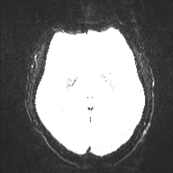 Acute disseminated encephalomyelitis (Radiopaedia 37253-39033 Axial DWI 15).jpg