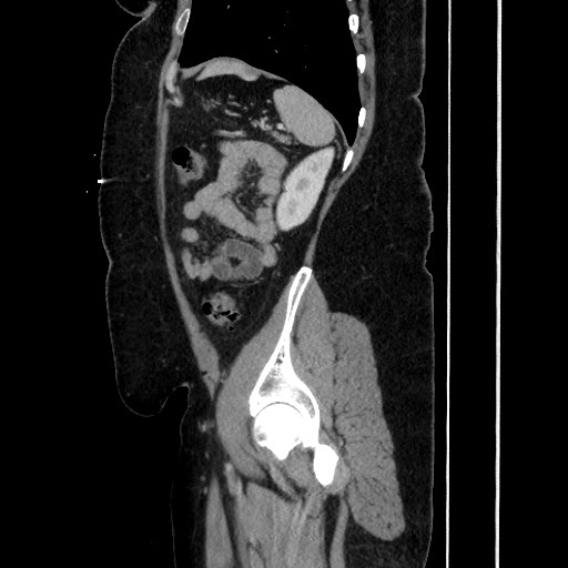 Acute diverticulitis - transverse colon (Radiopaedia 87063-103327 Sagittal C+ portal venous phase 168).jpg