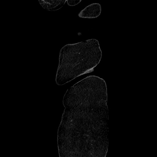 Acute diverticulitis - transverse colon (Radiopaedia 87063-103327 Sagittal C+ portal venous phase 22).jpg