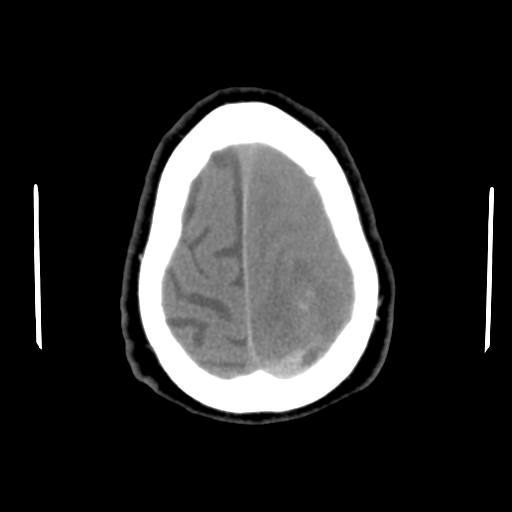 Acute hemorrhagic stroke (Radiopaedia 17507-17223 Axial non-contrast 45).jpg