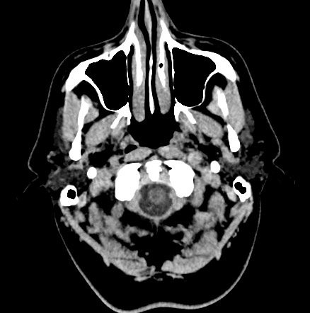 Acute internal carotid artery dissection (Radiopaedia 53541-59558 Axial non-contrast 3).jpg