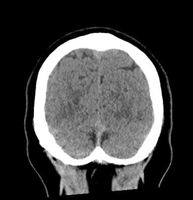 Acute internal carotid artery dissection (Radiopaedia 53541-59558 Coronal non-contrast 66).jpg