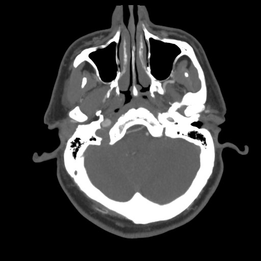File:Acute internal carotid artery dissection (Radiopaedia 53541-59630 D 15).jpg