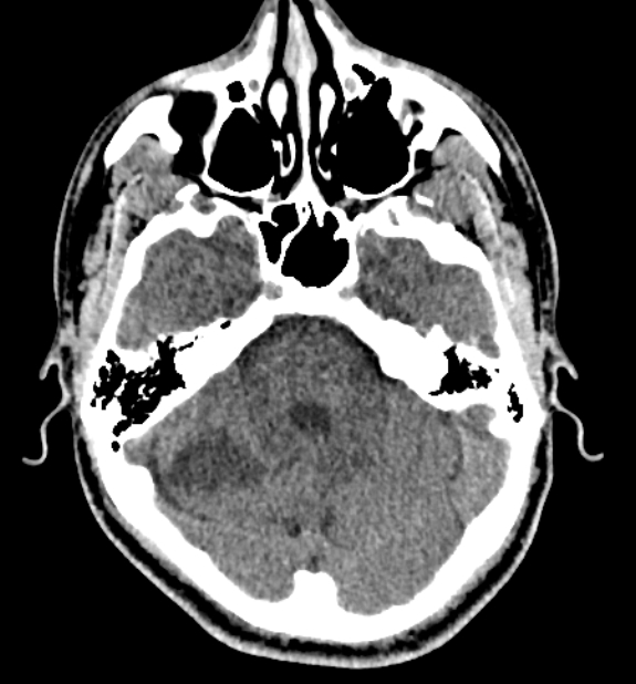 Acute ischemic stroke - posterior circulation territory (Radiopaedia 77670-89881 non-contrast 23).jpg