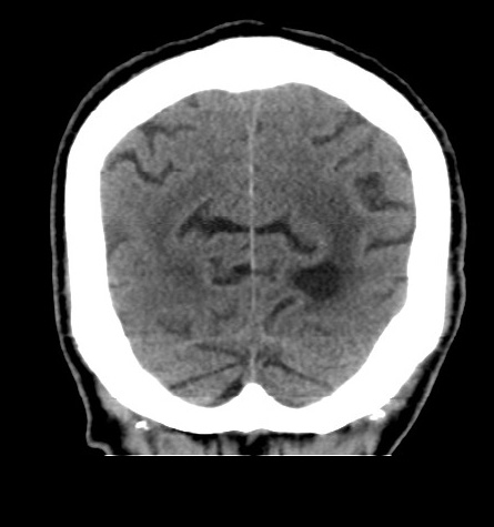 Acute left anterior cerebral artery territory infarction (Radiopaedia 51785-57578 Coronal non-contrast 50).jpg