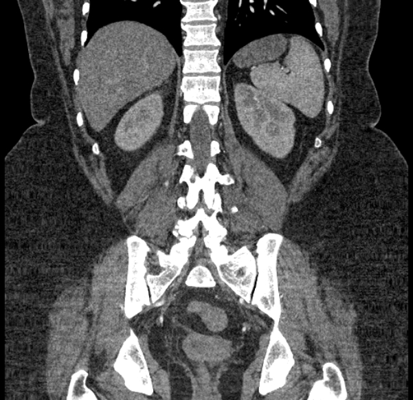 Acute mesenteric ischemia (Radiopaedia 80029-93316 Coronal C+ arterial phase 103).jpg