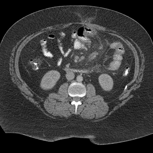Acute mesenteric venous ischemia (Radiopaedia 46041-50383 Axial C+ portal venous phase 59).jpg