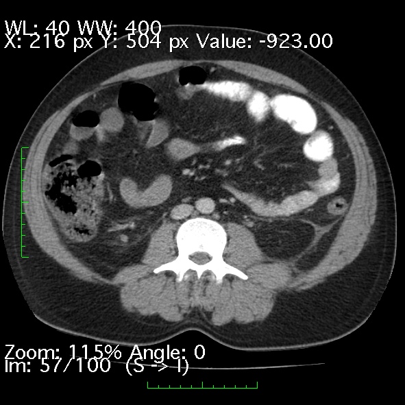 Acute pancreatitis (Radiopaedia 34043-35276 Axial C+ portal venous phase 57).jpg