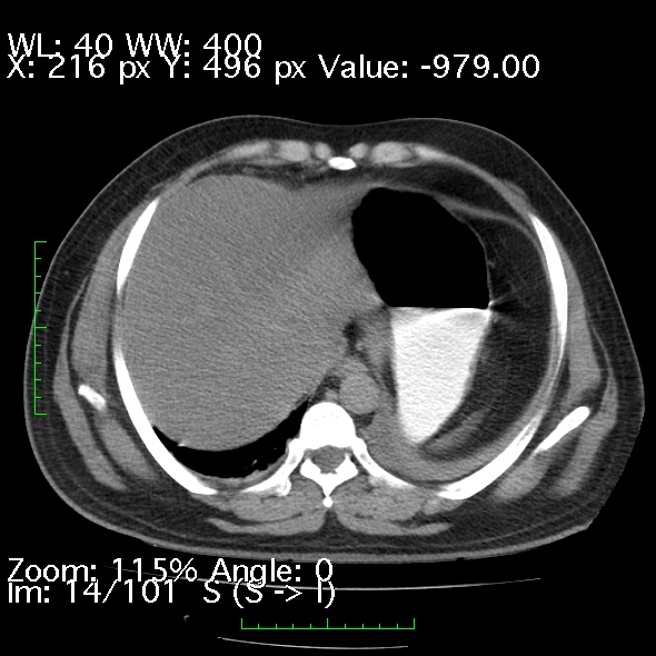Acute pancreatitis (Radiopaedia 34043-35276 Axial non-contrast 14).jpg