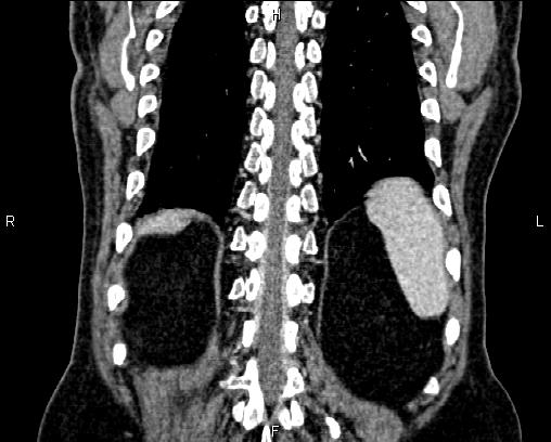 Acute pancreatitis (Radiopaedia 85146-100701 Coronal C+ portal venous phase 64).jpg