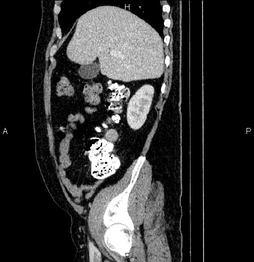 Acute pancreatitis (Radiopaedia 85390-101010 Sagittal C+ portal venous phase 21).jpg