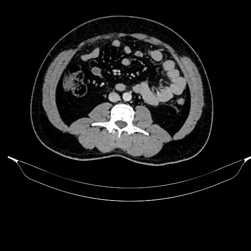 Acute pancreatitis (Radiopaedia 87428-103757 Axial C+ portal venous phase 55).jpg