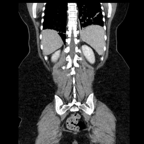 Acute pancreatitis - Balthazar C (Radiopaedia 26569-26714 Coronal C+ portal venous phase 54).jpg