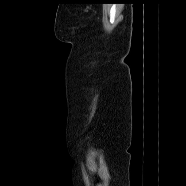 Acute pancreatitis - Balthazar C (Radiopaedia 26569-26714 Sagittal C+ portal venous phase 7).jpg