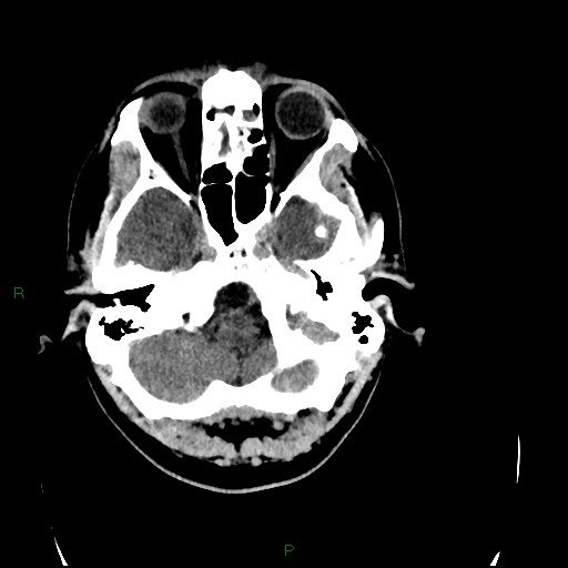 Acute posterior cerebral artery territory infarct (Radiopaedia 79329-92393 Axial non-contrast 19).jpg