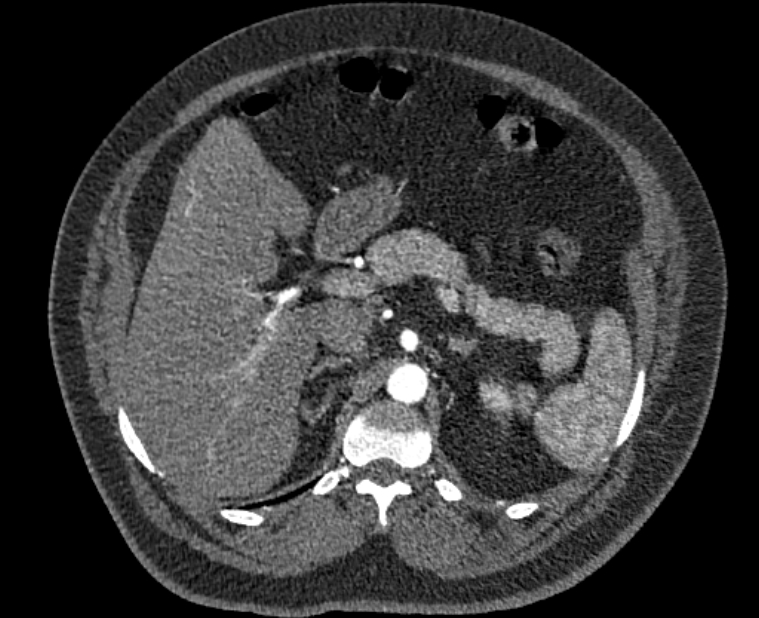 Acute pulmonary embolism with pulmonary infarcts (Radiopaedia 77688-89908 Axial C+ CTPA 79).jpg