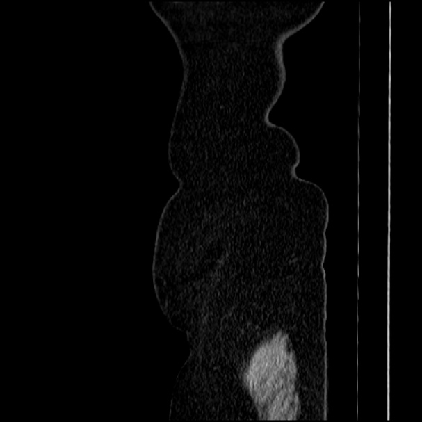 Acute pyelonephritis (Radiopaedia 33397-34434 Sagittal renal parenchymal phase 89).jpg