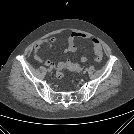 Acute renal artery occlusion (Radiopaedia 86586-102682 Axial non-contrast 73).jpg