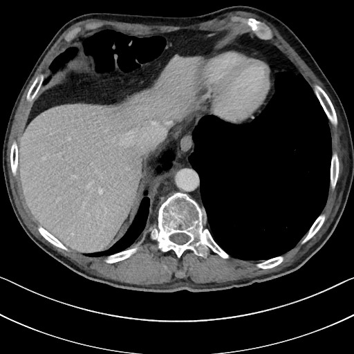 Acute renal infarction - rim capsular enhancement (Radiopaedia 59833-67270 Axial C+ portal venous phase 13).jpg