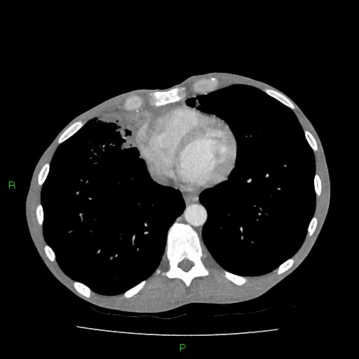 File:Acute right lung abscess (Radiopaedia 34806-36258 Axial C+ arterial phase 133).jpg