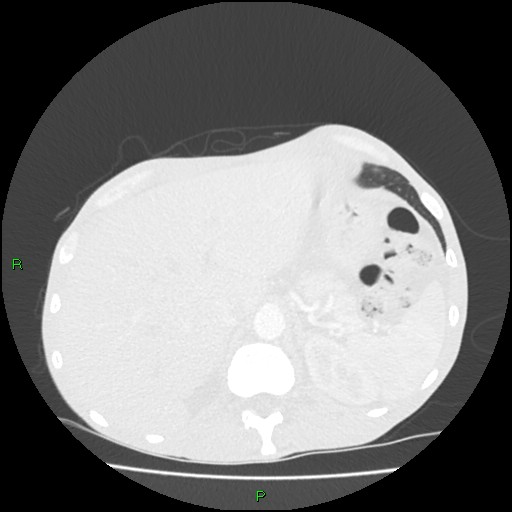 Acute right lung abscess (Radiopaedia 34806-36258 Axial lung window 181).jpg