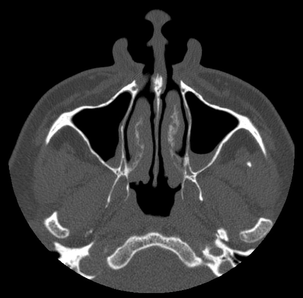 Acute sinusitis (Radiopaedia 23161-23215 Axial bone window 18).jpg