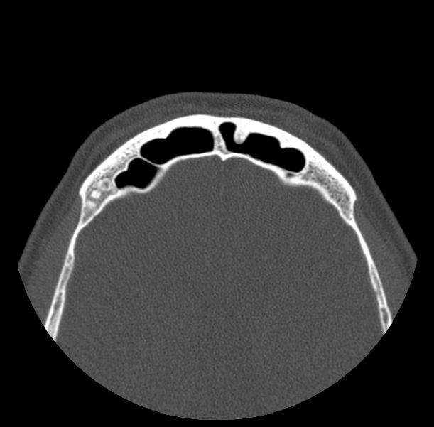 Acute sinusitis (Radiopaedia 23161-23215 Axial bone window 69).jpg