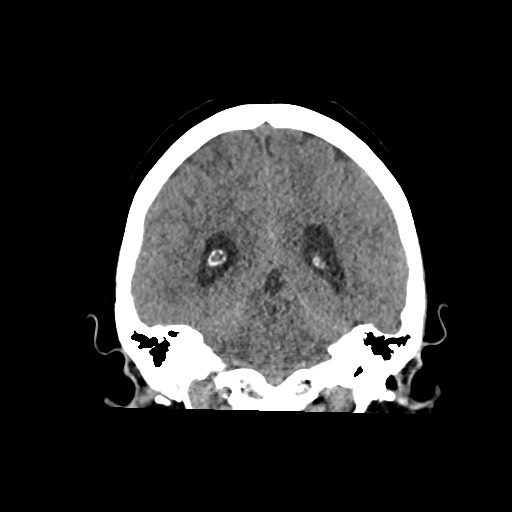 Acute subarachnoid hemorrhage and accessory anterior cerebral artery (Radiopaedia 69231-79008 Coronal non-contrast 47).jpg