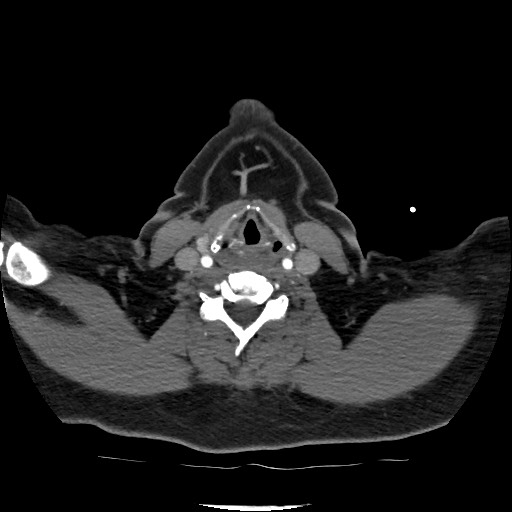 Acute subarachnoid hemorrhage and accessory anterior cerebral artery (Radiopaedia 69231-79009 Axial C+ arterial phase 43).jpg