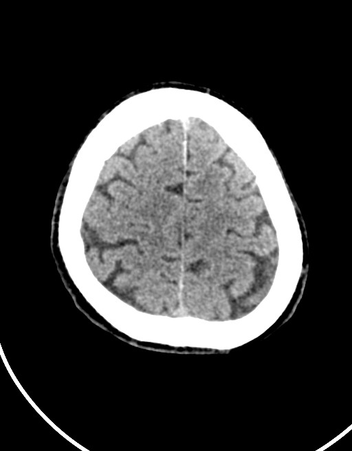 Acute superior cerebellar artery territory infarct (Radiopaedia 84104-99359 Axial non-contrast 17).jpg