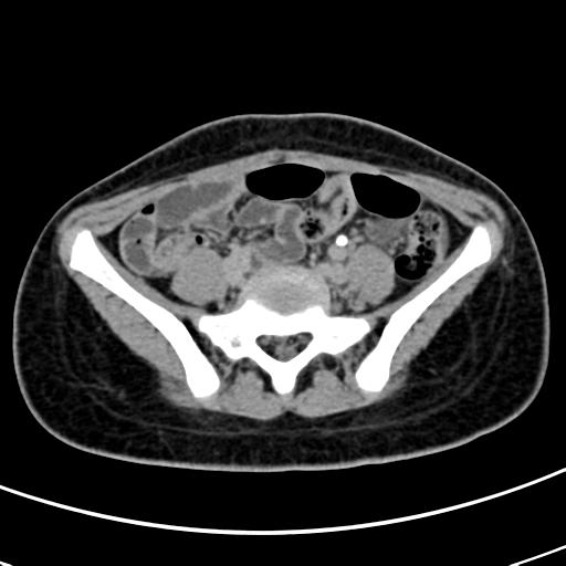Acute suppurative pyelonephritis (Radiopaedia 18306-18147 Axial renal excretory phase 117).jpg