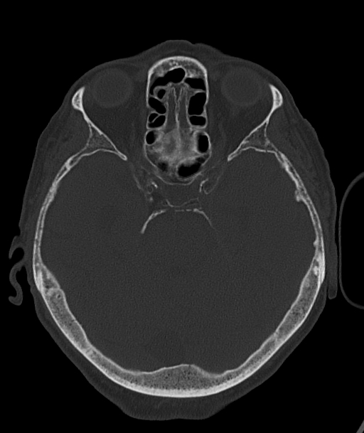 Acute traumatic subdural hematoma (Radiopaedia 82921-97257 Axial bone window 71).jpg