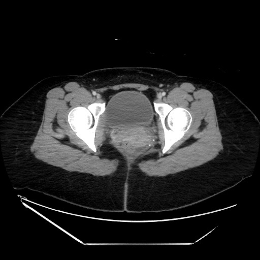 Acute uncomplicated appendicitis (Radiopaedia 73704-84499 Axial C+ portal venous phase 156).jpg