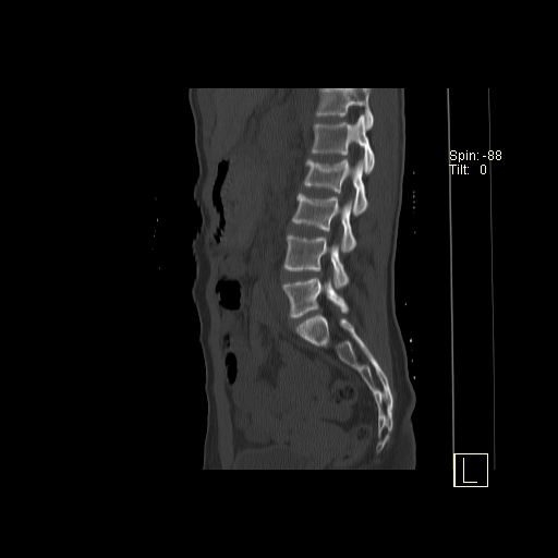 File:Acute vertebral compression fracture (Radiopaedia 63832-72559 Sagittal bone window 6).jpg