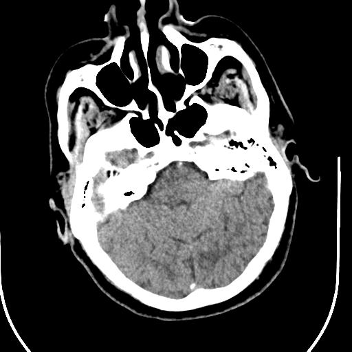 Acute vertebrobasilar ischemic infarction (Radiopaedia 25220-25473 Axial non-contrast 18).jpg