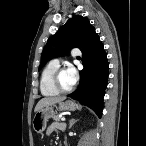Adenocarcinoma of the lung (Radiopaedia 59871-67325 Sagittal C+ arterial phase 64).jpg