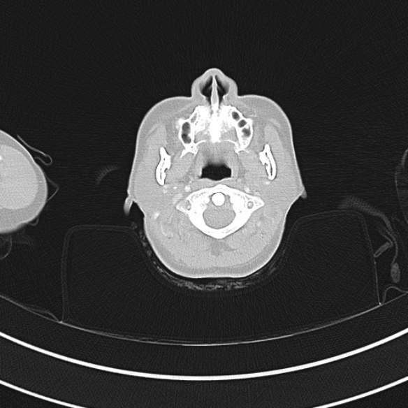 Adenocystic carcinoma of the trachea (Radiopaedia 47677-52525 Axial lung window 7).jpg