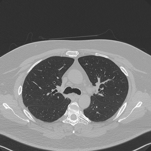 Adenoid cystic carcinoma of the trachea (Radiopaedia 49042-54137 Axial lung window 121).jpg