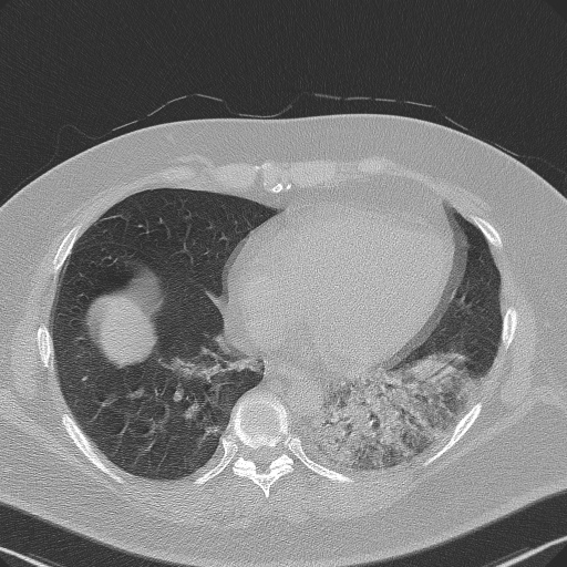 Adenoid cystic carcinoma of the trachea (Radiopaedia 49042-54137 Axial lung window 243).jpg