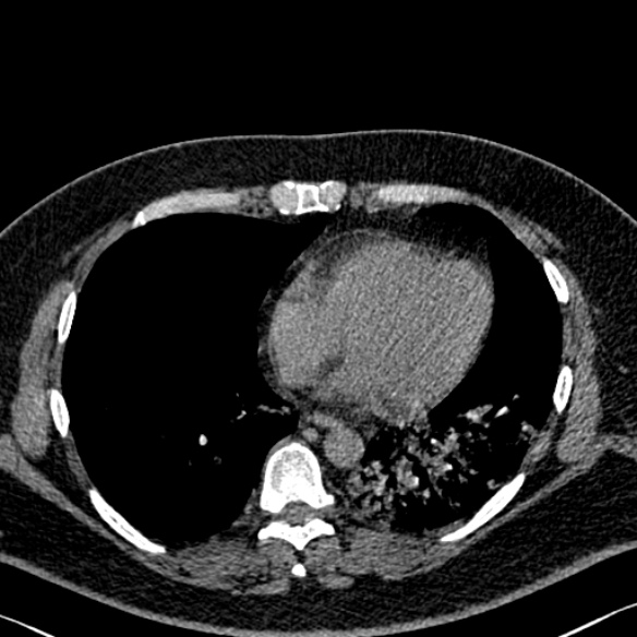 File:Adenoid cystic carcinoma of the trachea (Radiopaedia 49042-54137 Axial non-contrast 233).jpg