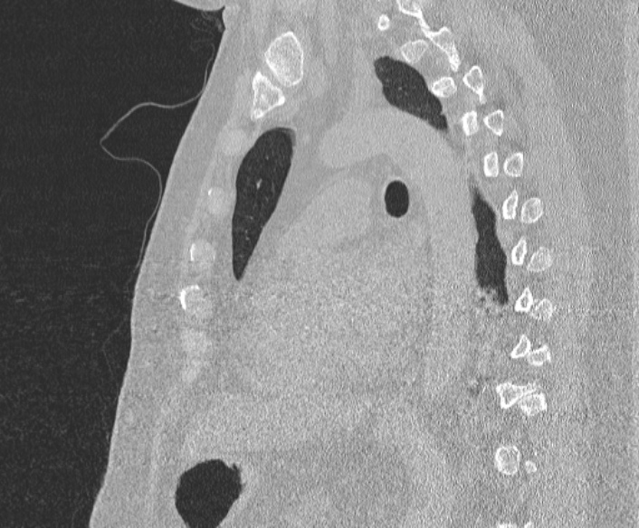 File:Adenoid cystic carcinoma of the trachea (Radiopaedia 49042-54137 Sagittal lung window 270).jpg