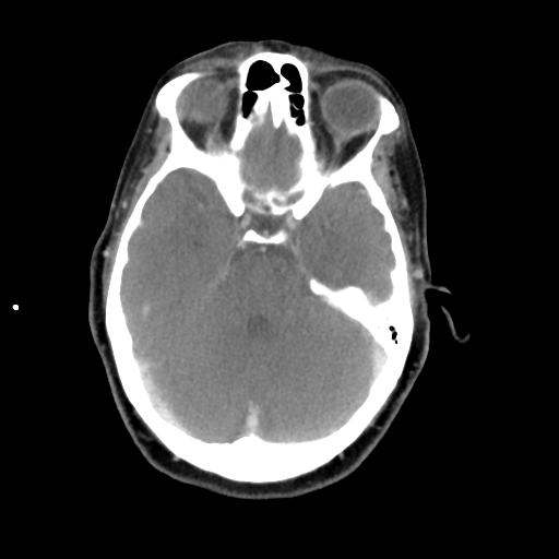 File:Adenoid cystic tumor of palate (Radiopaedia 46980-51518 Axial C+ delayed 10).png