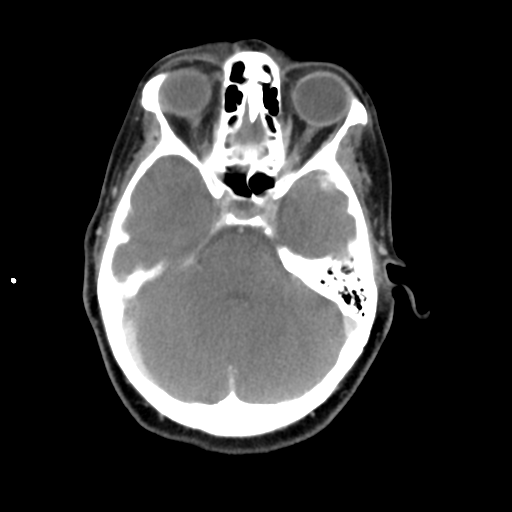 File:Adenoid cystic tumor of palate (Radiopaedia 46980-51518 Axial C+ delayed 11).png