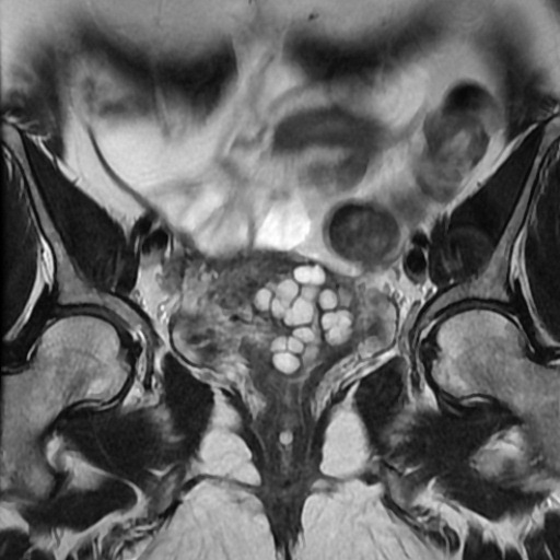 File:Adenoma malignum of cervix (Radiopaedia 66441-75705 Coronal T2 5).jpg